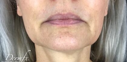 Ultherapy Before & After Patient #918