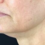 Ultherapy Before & After Patient #918