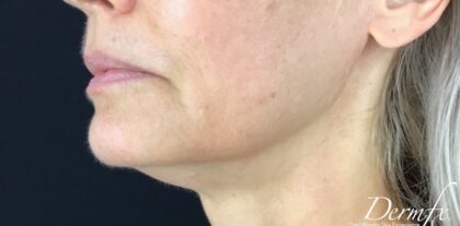 Ultherapy Before & After Patient #918