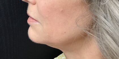 Ultherapy Before & After Patient #918