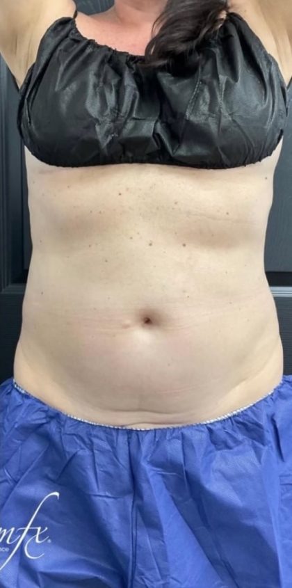 CoolSculpting Before & After Patient #1573