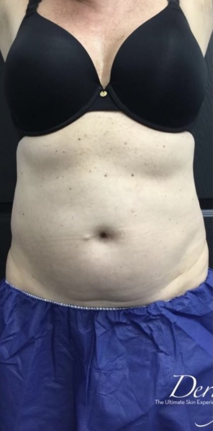 CoolSculpting Before & After Patient #1573