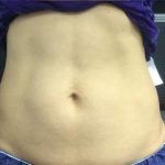 CoolSculpting Before & After Patient #1646