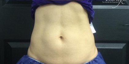 CoolSculpting Before & After Patient #1646