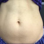 CoolSculpting Before & After Patient #1646