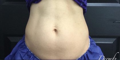 CoolSculpting Before & After Patient #1646