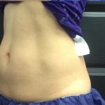 CoolSculpting Before & After Patient #1646