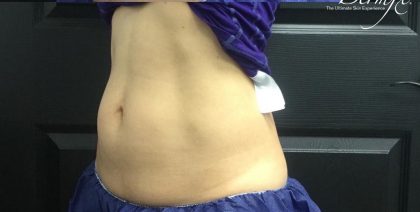 CoolSculpting Before & After Patient #1646