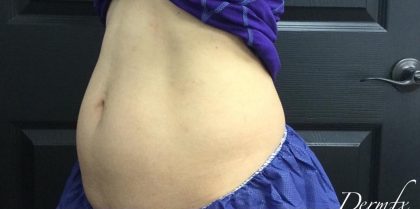 CoolSculpting Before & After Patient #1646