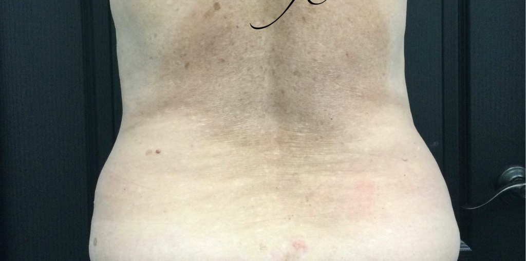 CoolSculpting Before & After Patient #1655