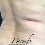 CoolSculpting Before & After Patient #1655