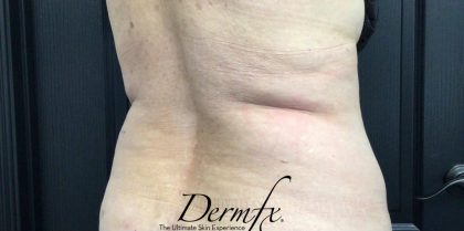 CoolSculpting Before & After Patient #1655