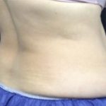 CoolSculpting Before & After Patient #1660