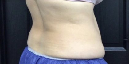 CoolSculpting Before & After Patient #1660