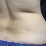 CoolSculpting Before & After Patient #1660