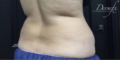 CoolSculpting Before & After Patient #1660