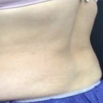 CoolSculpting Before & After Patient #1660