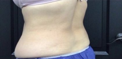 CoolSculpting Before & After Patient #1660