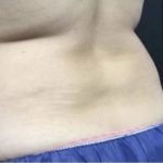 CoolSculpting Before & After Patient #1660
