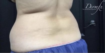 CoolSculpting Before & After Patient #1660