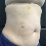 CoolSculpting Before & After Patient #1668