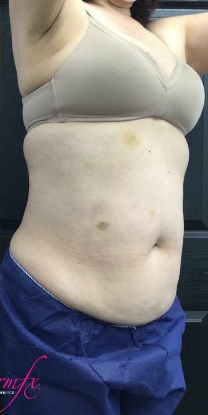 CoolSculpting Before & After Patient #1668