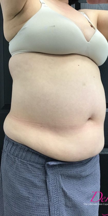 CoolSculpting Before & After Patient #1668