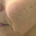 Microneedling Before & After Patient #1467