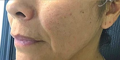 Microneedling Before & After Patient #1467