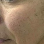 Microneedling Before & After Patient #1467