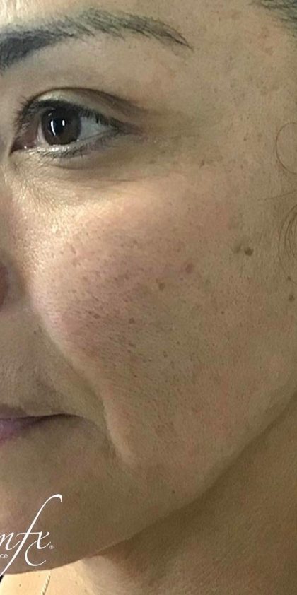 Microneedling Before & After Patient #1467