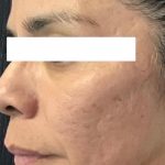 Microneedling Before & After Patient #1467