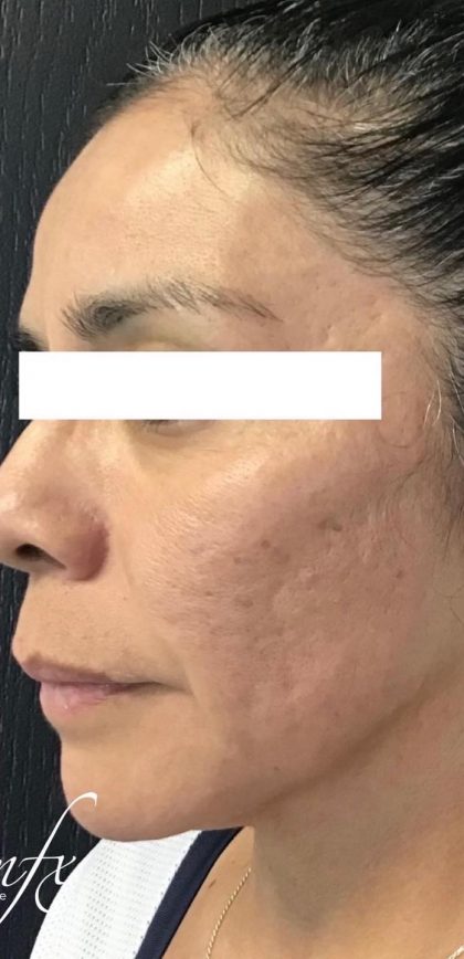 Microneedling Before & After Patient #1467