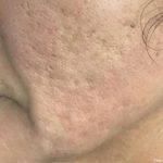 Microneedling Before & After Patient #1467