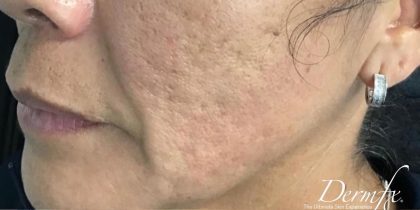 Microneedling Before & After Patient #1467