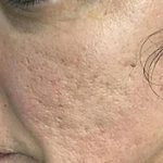 Microneedling Before & After Patient #1467