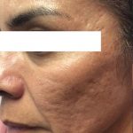 Microneedling Before & After Patient #1467