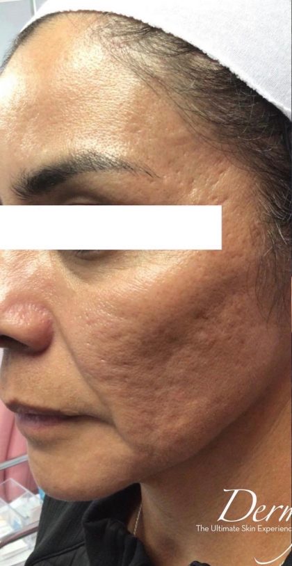 Microneedling Before & After Patient #1467