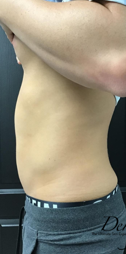 EMSCULPT NEO Before & After Patient #1387