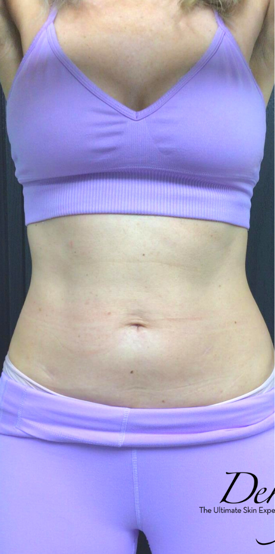 EMSCULPT NEO Before & After Patient #1378