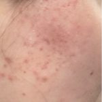 Agnes RF Before & After Patient #1430