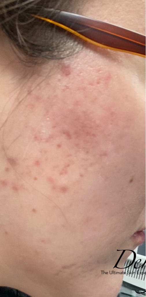 Agnes RF Before & After Patient #1430