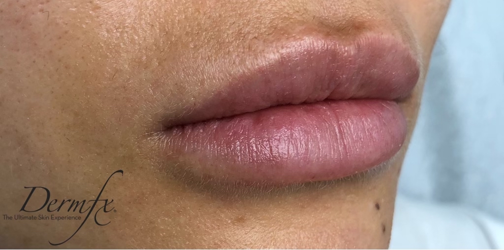 Restylane Before & After Patient #1588