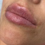 Juvederm Ultra Before & After Patient #1592