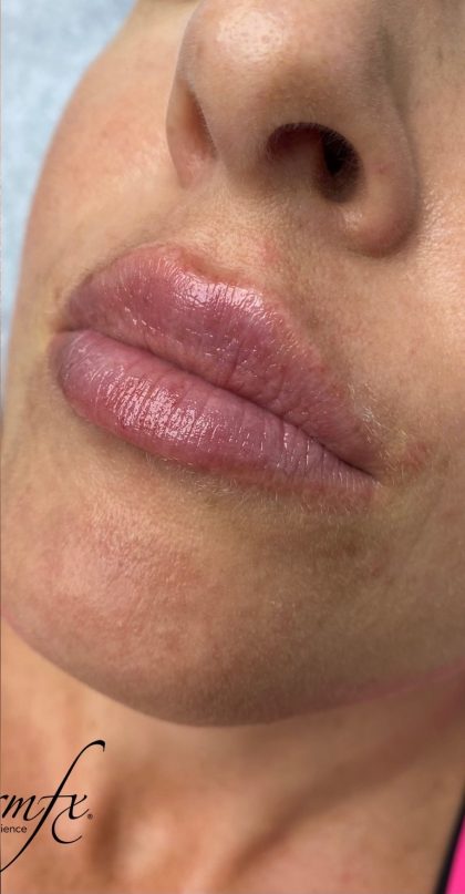 Juvederm Ultra Before & After Patient #1592