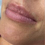 Juvederm Ultra Before & After Patient #1592