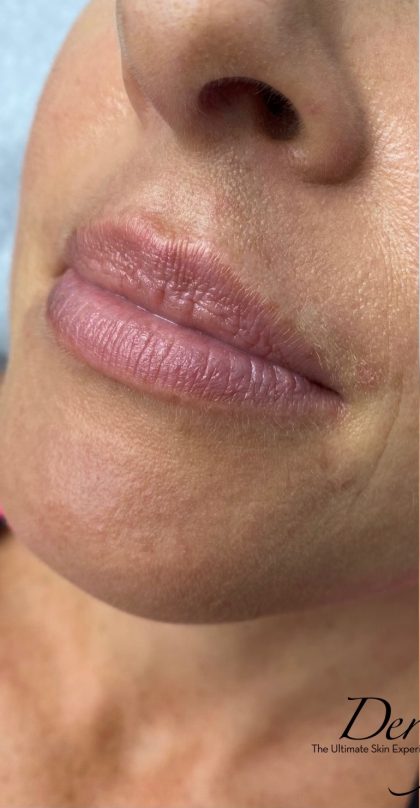 Juvederm Ultra Before & After Patient #1592