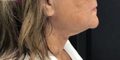 Thread Lift Before & After Patient #1527
