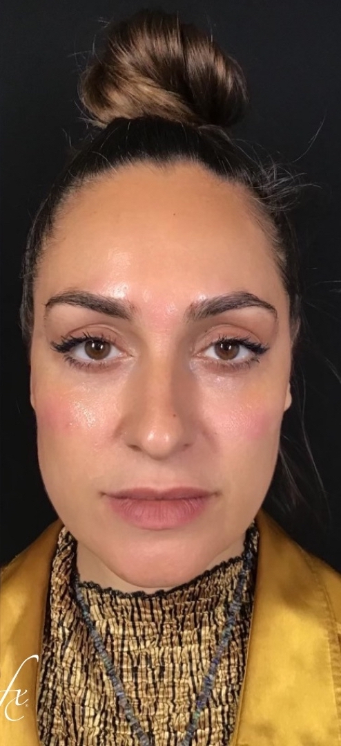 Belotero Balance Before & After Patient #1429