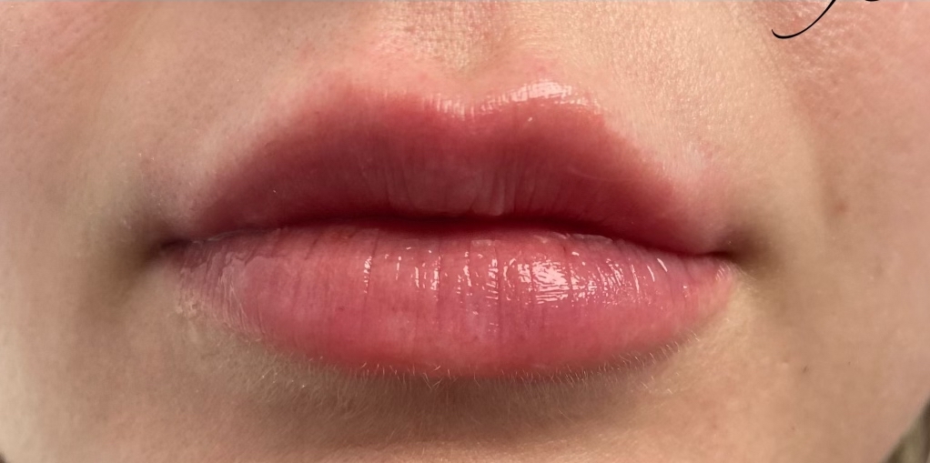 Restylane Before & After Patient #1634